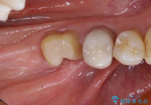 40代女性　奥歯のインプラントと分岐部病変の処置(ルートセパレーション)～インプラントと歯肉移植の治療前