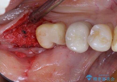 40代女性　奥歯のインプラントと分岐部病変の処置(ルートセパレーション)～インプラントと歯肉移植の治療中