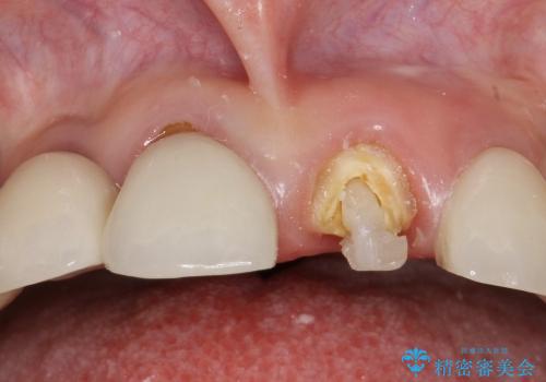 40代女性　「前歯が浮いている」　土台ごと折れた前歯の修復　の治療前
