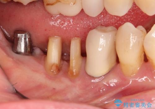 40代女性　奥歯のインプラントと分岐部病変の処置(ルートセパレーション)～インプラントと歯肉移植の治療後