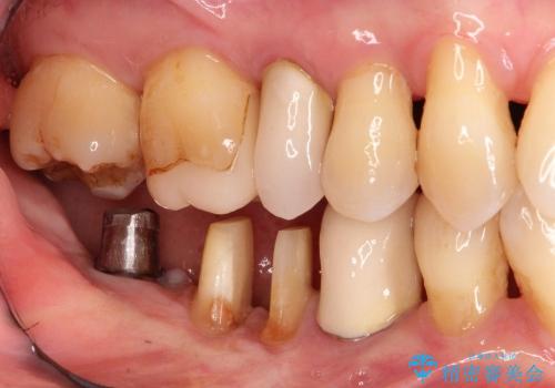40代女性　奥歯のインプラントと分岐部病変の処置(ルートセパレーション)の治療中