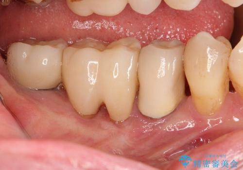 40代女性　奥歯のインプラントと分岐部病変の処置(ルートセパレーション)～インプラントと歯肉移植の治療後