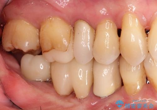 40代女性　奥歯のインプラントと分岐部病変の処置(ルートセパレーション)の症例 治療後