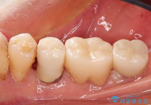 40代女性　奥歯のインプラントと分岐部病変の処置(ルートセパレーション)の治療後