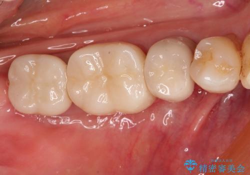 40代女性　奥歯のインプラントと分岐部病変の処置(ルートセパレーション)～インプラントと歯肉移植の症例 治療後