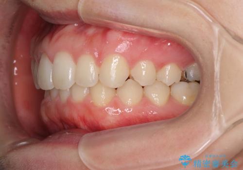 インビザラインによる出っ歯とすきっ歯の改善の治療後