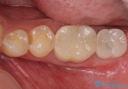 咬めない奥歯を咬めるように　ストローマンインプラントによる咬合回復の治療後