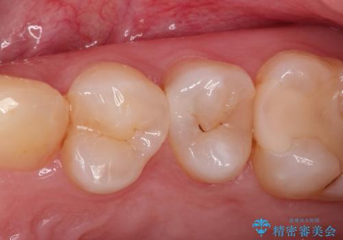 むし歯治療　早期発見・早期治療　(セラミックインレーにて修復)の症例 治療前