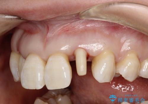 30代女性　前歯の限局的な歯周病を治療する②～被せものの製作の治療中