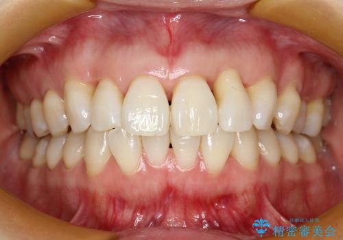 30代女性　前歯の限局的な歯周病を治療する①～再生治療の治療後