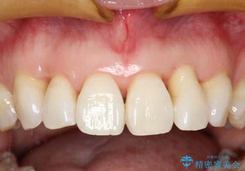 30代女性　前歯の限局的な歯周病を治療する②～被せものの製作の治療前