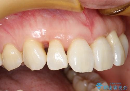 30代女性　前歯の限局的な歯周病を治療する②～被せものの製作の治療前