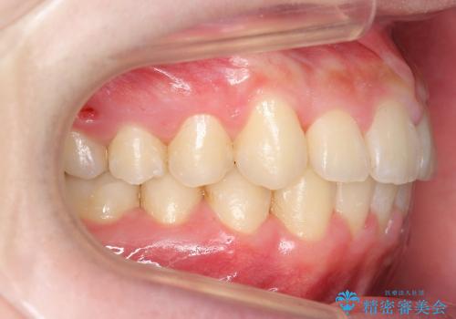 抜かない矯正　出っ歯を大きく下げました　乳歯が残って異所萌出　奥歯のすれ違い咬合の治療後