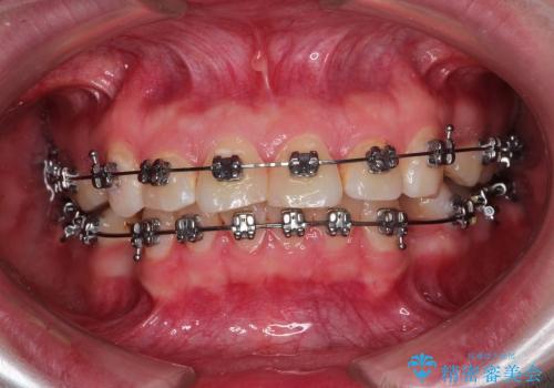 出っ歯の矯正、できるだけ安い装置での治療中