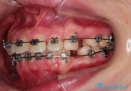 出っ歯の矯正、できるだけ安い装置での治療中