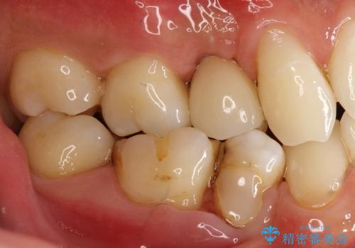 30代男性　歯が無い→インプラントで回復　サイナスソケットリフトの併用の症例 治療後