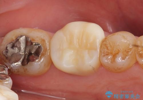治療途中の歯の補綴の治療前