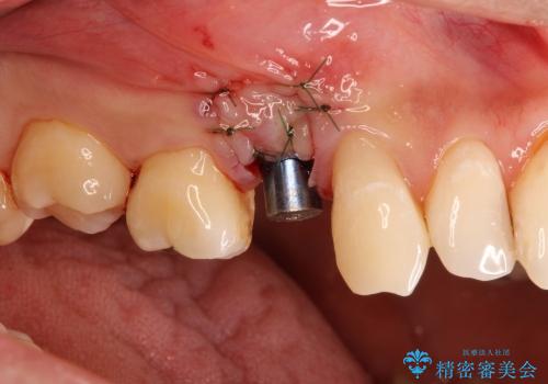 30代男性　歯が無い→インプラントで回復　サイナスソケットリフトの併用の治療中