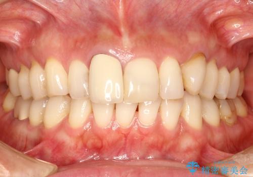 30代女性　部分矯正を駆使して歯ぐきのラインと歯軸をそろえるの治療前