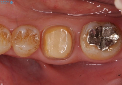 治療途中の歯の補綴の治療中