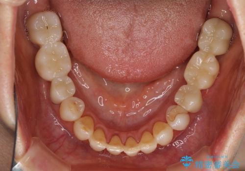 咬み合わせが悪くて奥歯が抜歯に　矯正治療と奥歯のセラミックブリッジの治療後