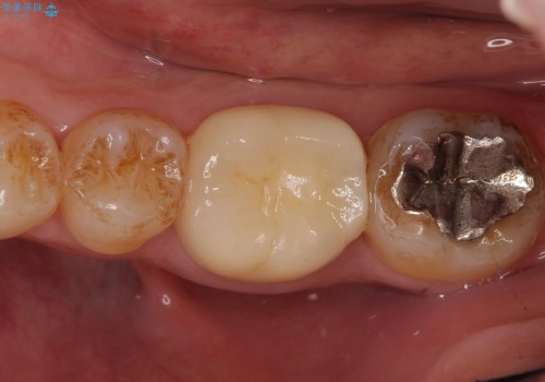 治療途中の歯の補綴