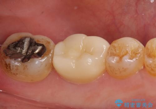 治療途中の歯の補綴の治療後