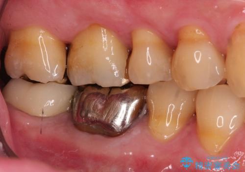 虫歯になっている歯の補綴と適合の悪いかぶせ物の再補綴の治療後