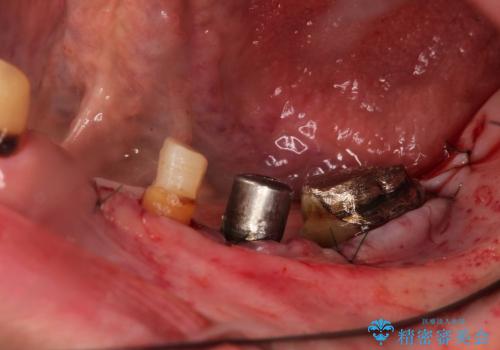噛めないところをインプラントに、残せない歯を残す治療の治療中