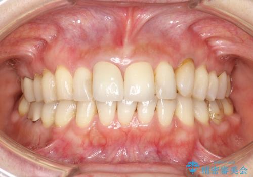 30代女性　部分矯正を駆使して歯ぐきのラインと歯軸をそろえるの治療後