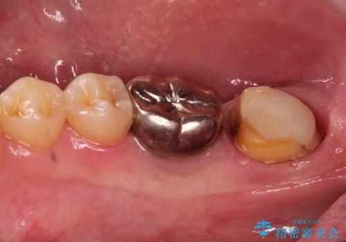 虫歯になっている歯の補綴と適合の悪いかぶせ物の再補綴の治療中