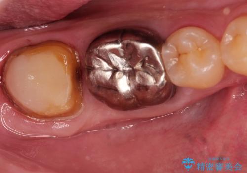 虫歯になっている歯の補綴と適合の悪いかぶせ物の再補綴の治療中