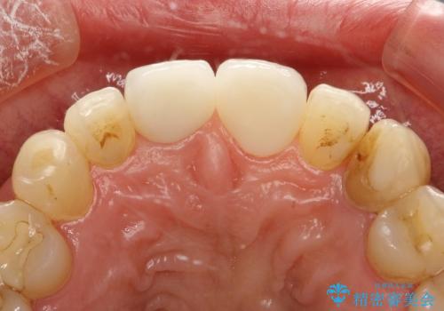 30代女性　部分矯正を駆使して歯ぐきのラインと歯軸をそろえるの治療後