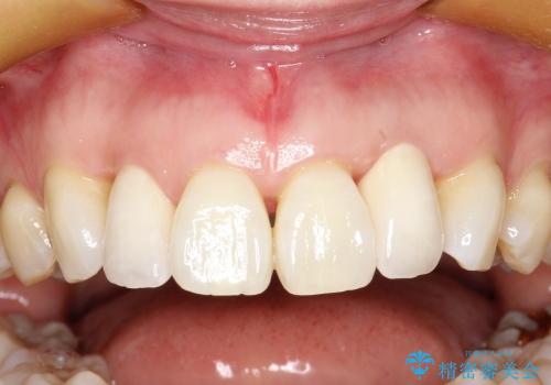 30代女性　前歯の限局的な歯周病を治療する②～被せものの製作の治療後