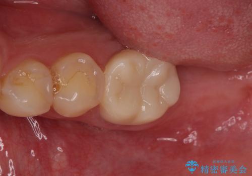 咬めない奥歯を咬めるように　ストローマンインプラントによる咬合回復の症例 治療前