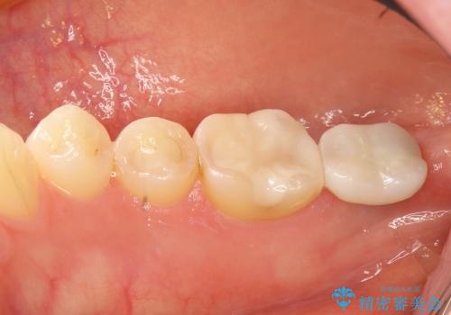 30代女性　奥歯のショートインプラントの症例 治療後