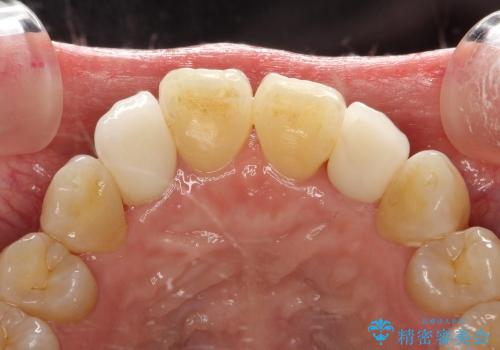 30代女性　前歯の限局的な歯周病を治療する②～被せものの製作の治療後