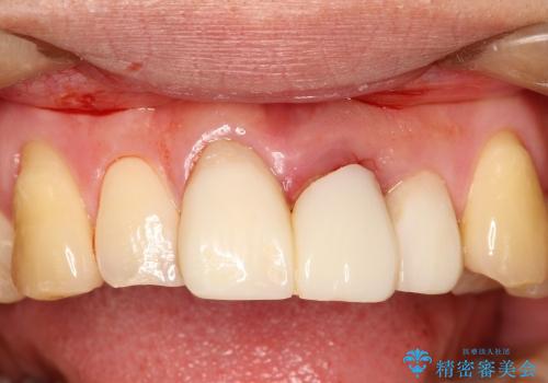 前歯のブリッジ治療　部分矯正を併用して歯茎の形態をコントロールの治療前