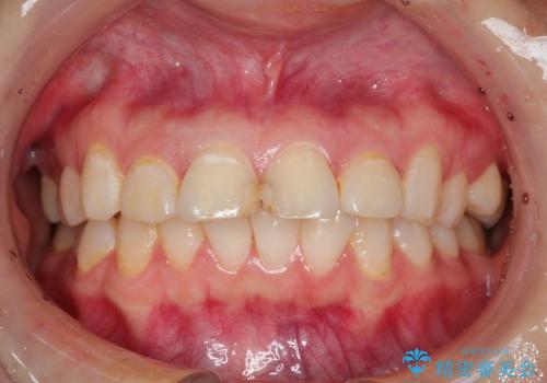 出っ歯の矯正、できるだけ安い装置での症例 治療前