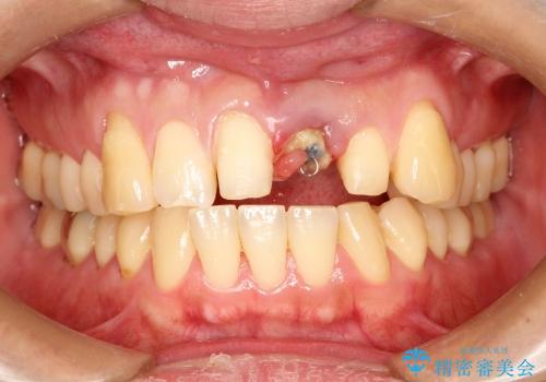 前歯のブリッジ治療　部分矯正を併用して歯茎の形態をコントロールの治療中