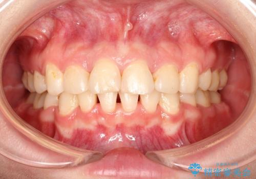 出っ歯の矯正、できるだけ安い装置での症例 治療後
