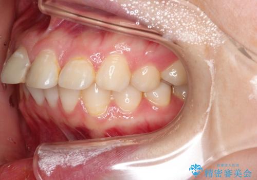 出っ歯の矯正、できるだけ安い装置での治療前