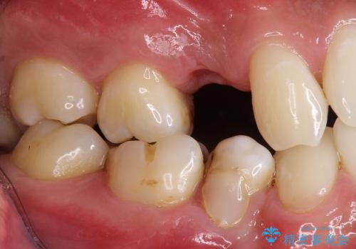 30代男性　歯が無い→インプラントで回復　サイナスソケットリフトの併用の症例 治療前