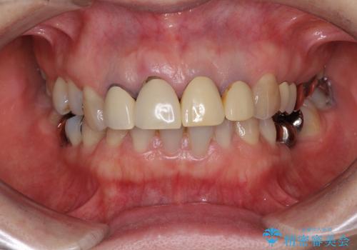 前歯が折れた　歯肉移植を用いた前歯のオールセラミックブリッジの治療前