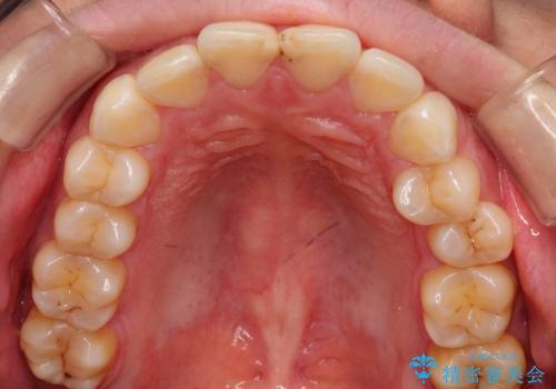 出っ歯の矯正、できるだけ安い装置での治療前