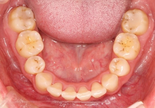 出っ歯の矯正、できるだけ安い装置での治療後