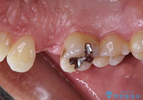 30代男性　歯が無い→インプラントで回復　サイナスソケットリフトの併用の治療前