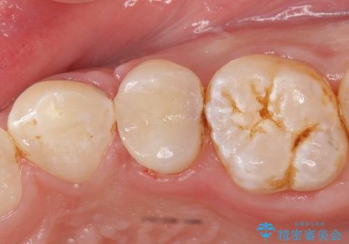 セラミックインレーによる虫歯治療の症例 治療後