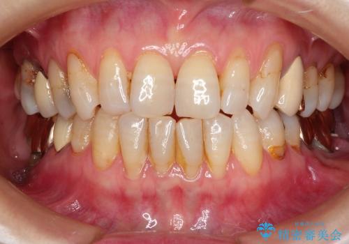 咬み合わせが悪くて奥歯が抜歯に　矯正治療と奥歯のセラミックブリッジの治療前