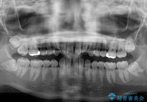 インビザラインによる出っ歯とすきっ歯の改善の治療前